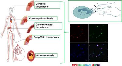 The Emerging Role of Neutrophil Extracellular Traps in Arterial, Venous and Cancer-Associated Thrombosis